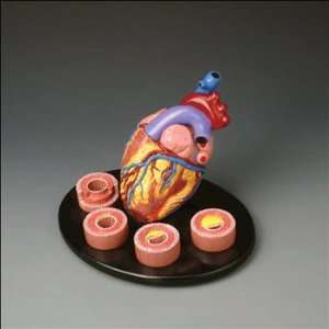 Anatomical Chart Company   Heart Conditions Model  